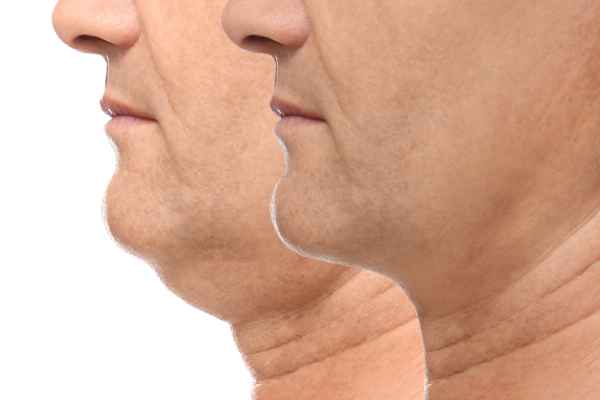 HIFU - Breakthrough in Anti - ageing 2 hifu results Shepperton Green