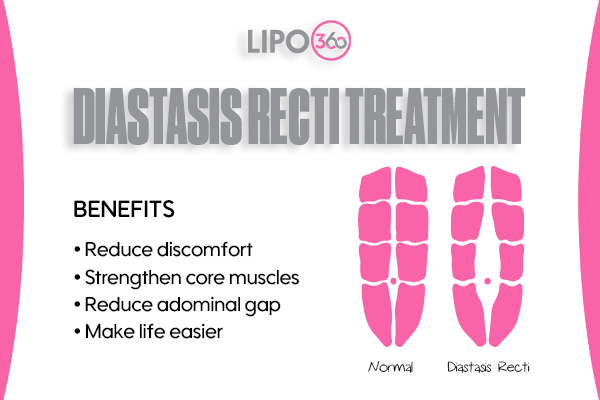 Revolutionising Muscle Repair: The Power of LIPO360 Body Sculpt Post-Injury 5 diastasis recti treatment Shepperton Green