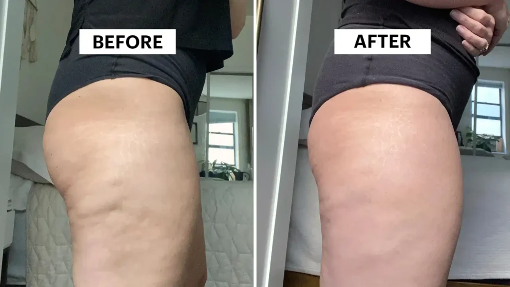 Sculpting Your Bum: Can Toning Exercises Really Reduce Cellulite? 1 Do Toning Exercise Shepperton Green Really Tackle Cellulite?