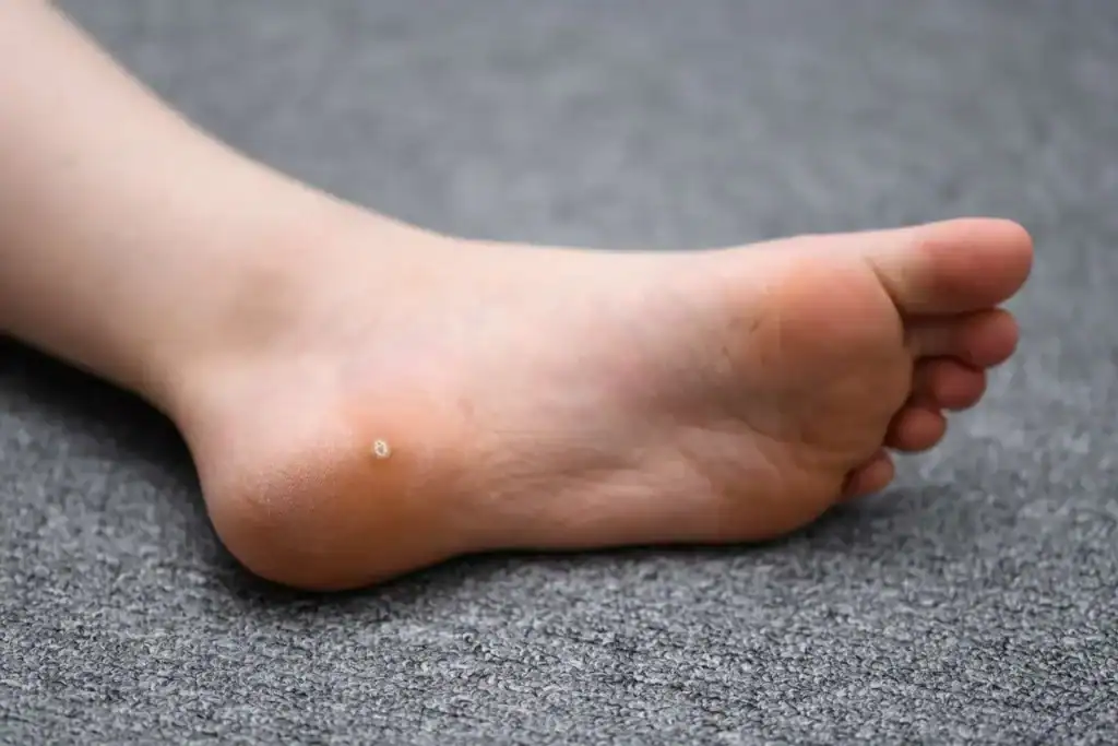 Cryotherapy For Warts And Also Verrucas 2 Image of verruca on the bottom of the foot that able to be treated with Cryotherapy Shepperton Green