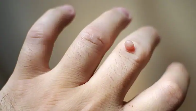 Cryotherapy For Warts And Also Verrucas 1 Image of blemish that Cryotherapy Shepperton Green can remove with Lipo 360.