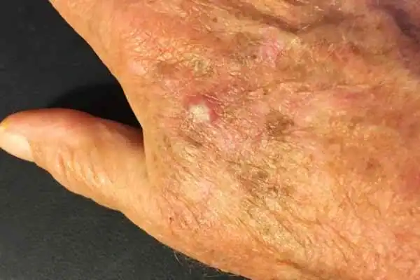 Cryopen For Actinic Keratoses 1 Image of Actinic keratoses Shepperton Green on a person hand