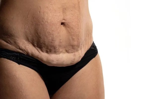 The Science of Skin Tightening 1 The science behind skin tightening Shepperton Green picture of a woman's sagging skin on the stomach